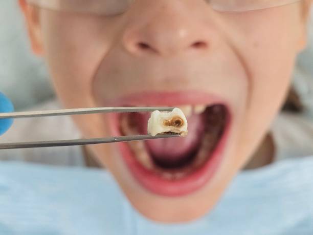Best Emergency Wisdom Teeth Removal in Canton, MS