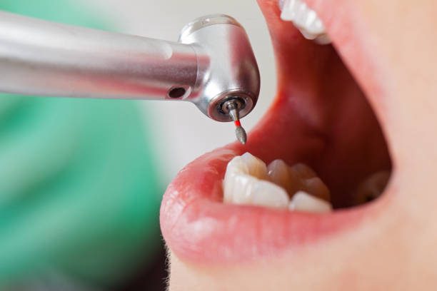 Best Emergency Treatment for Dental Infections or Abscesses in Canton, MS